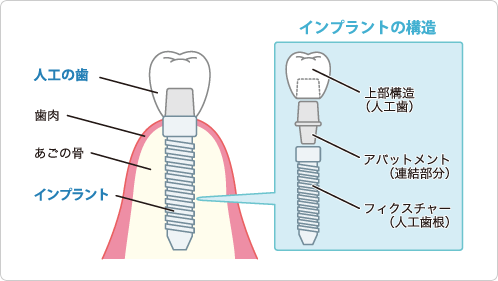 インプラント治療
