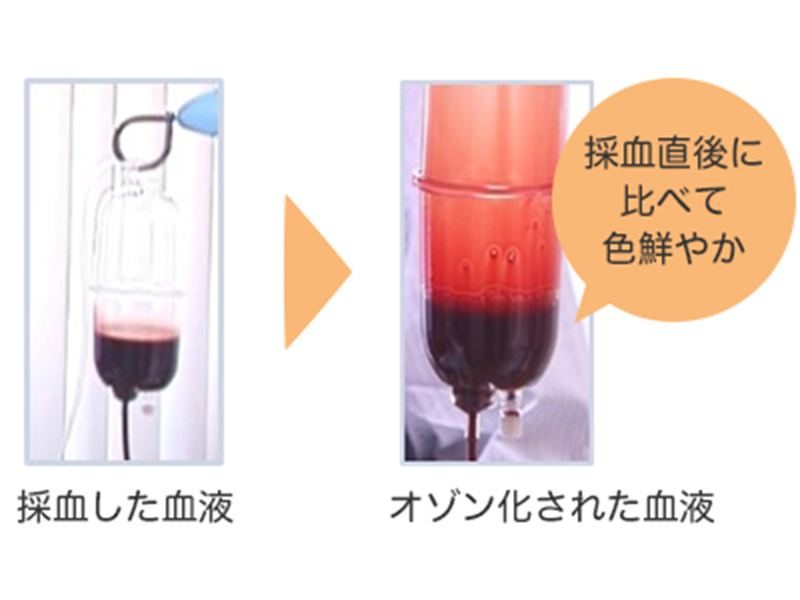 血液オゾン療法前後の血液の比較