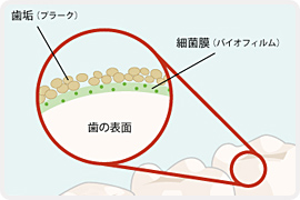 歯垢(プラーク)