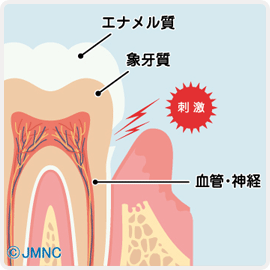 虫歯の放置により神経が腐っている状態