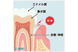歯周病